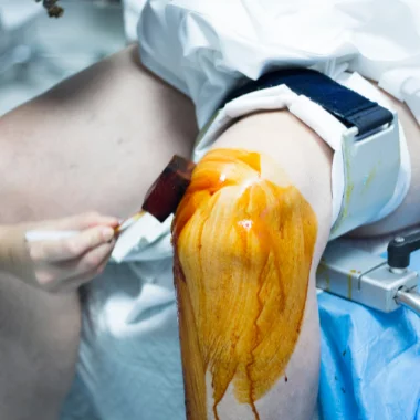1-Que-es-la-artroscopia-de-rodilla
